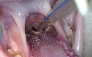 Intubación con sonda urinaria de 2 mm