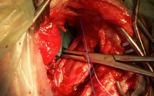 Cierre de la herida quirúrgica tras intervenir una hernia manteniendo la grasa hacia el interior