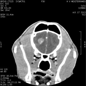 Tomografía computarizada que muestra una lesión intracraneal susceptible de neoplasia