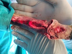Incisión de descarga para cerrar un gran defecto de piel tras extirpar un tumor en el carpo