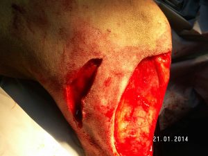 Incisión de descarga junto a una herida quirúrgica amplia tras extirpar un tumor