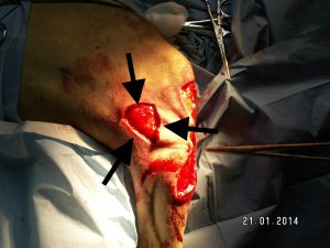 El cierre de la escisión del tumor se completa en linea aunque el cierre de la linea de descarga lateral se cierra en su mitad superior mediante una plastia en Y