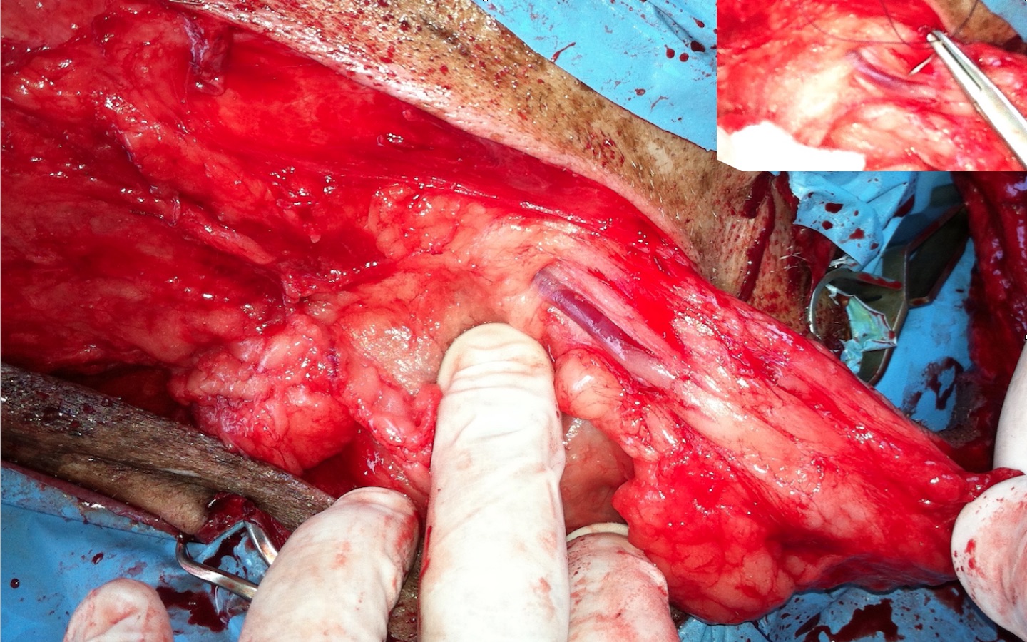 Cierre con doble sutura de los vasos epigástricos caudales que surgen del anillo inguinal.